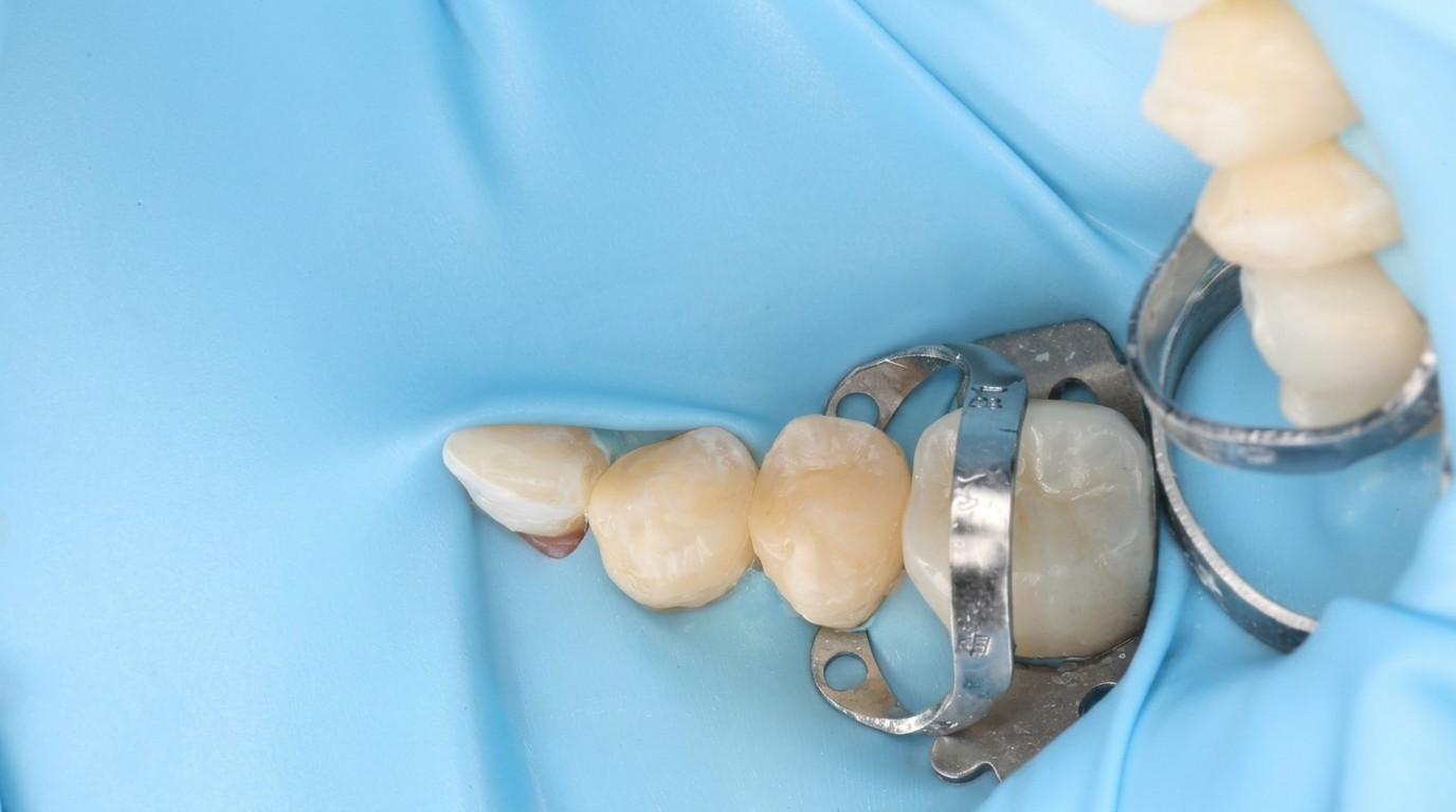 A row of completed tooth-coloured composite restorations on natural posterior teeth, isolated under a blue rubber dam.