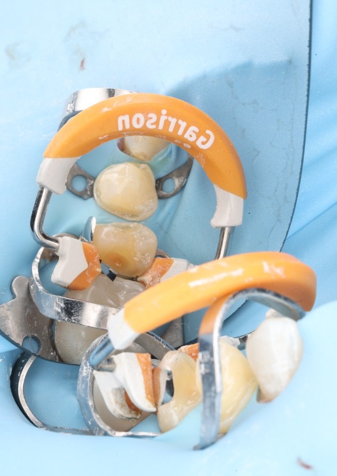 Garrison sectional matrix system with a separator ring in place around a posterior tooth being restored.