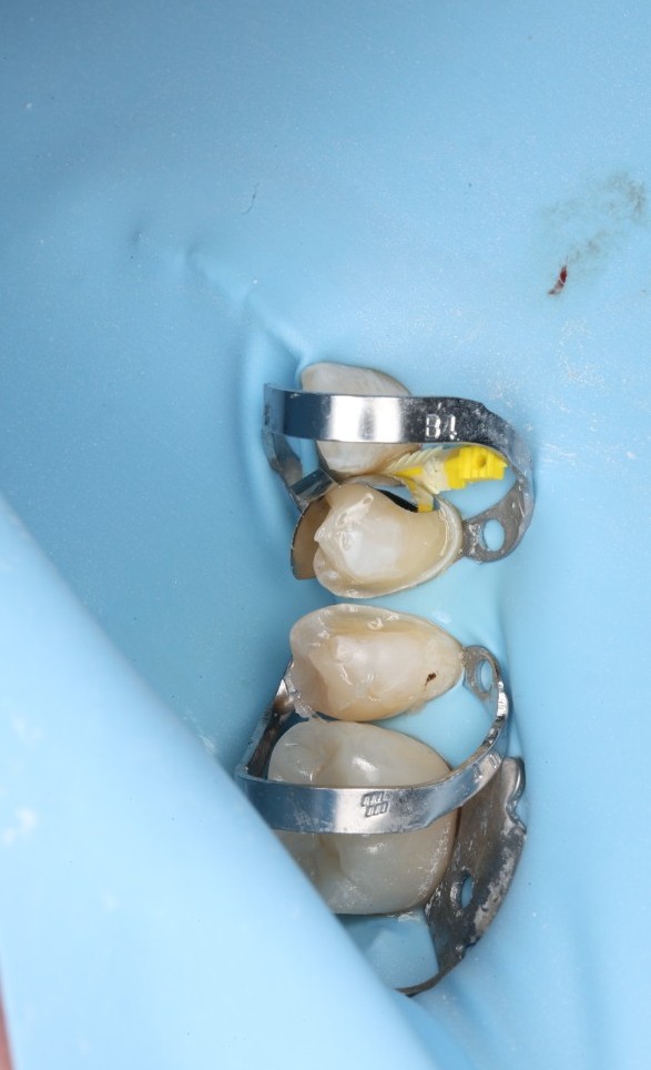 Two pairs of restored posterior teeth with matrix bands and a yellow interproximal wedge, isolated by a blue dam.