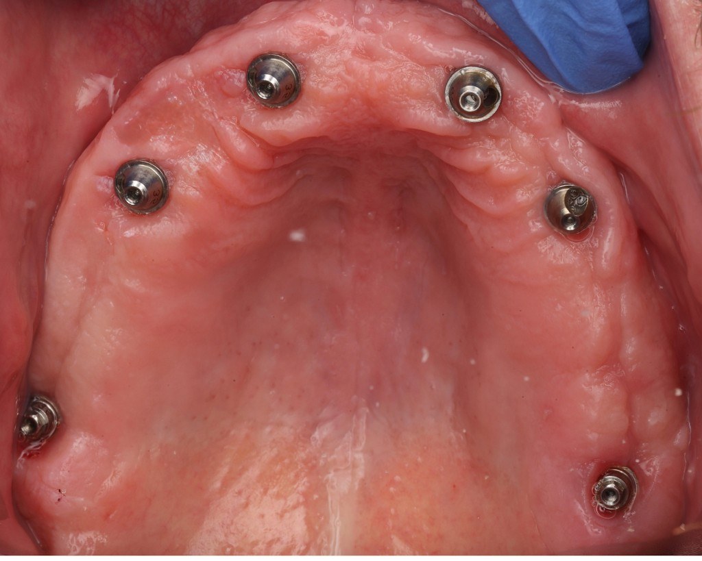 Top-down view of an arch with healed implant abutments.