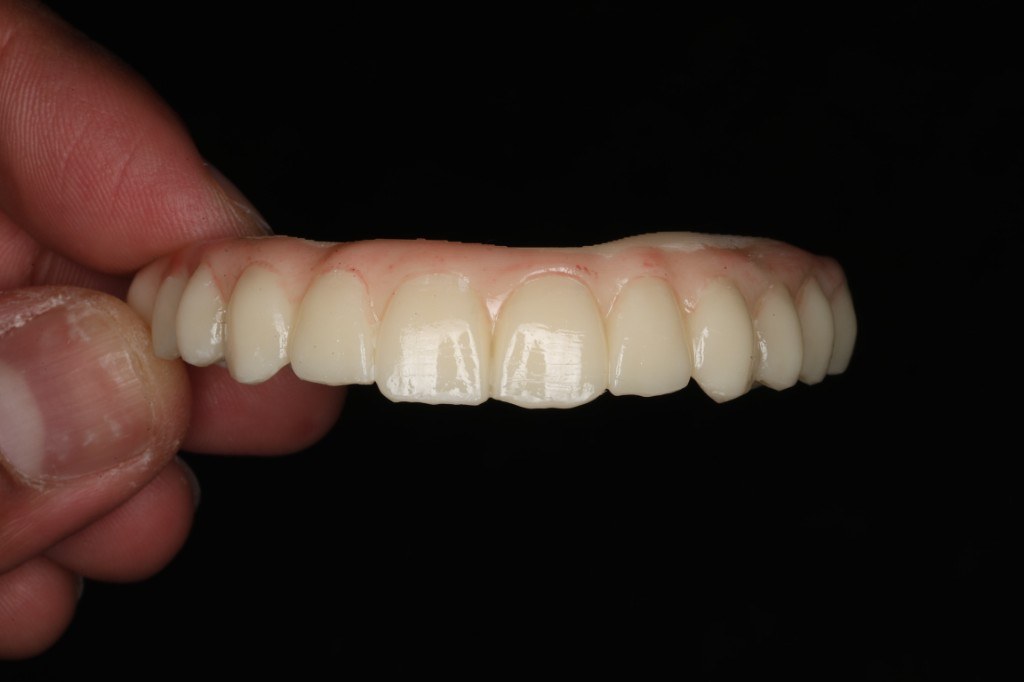 Implant prosthesis held by fingers — profile view.