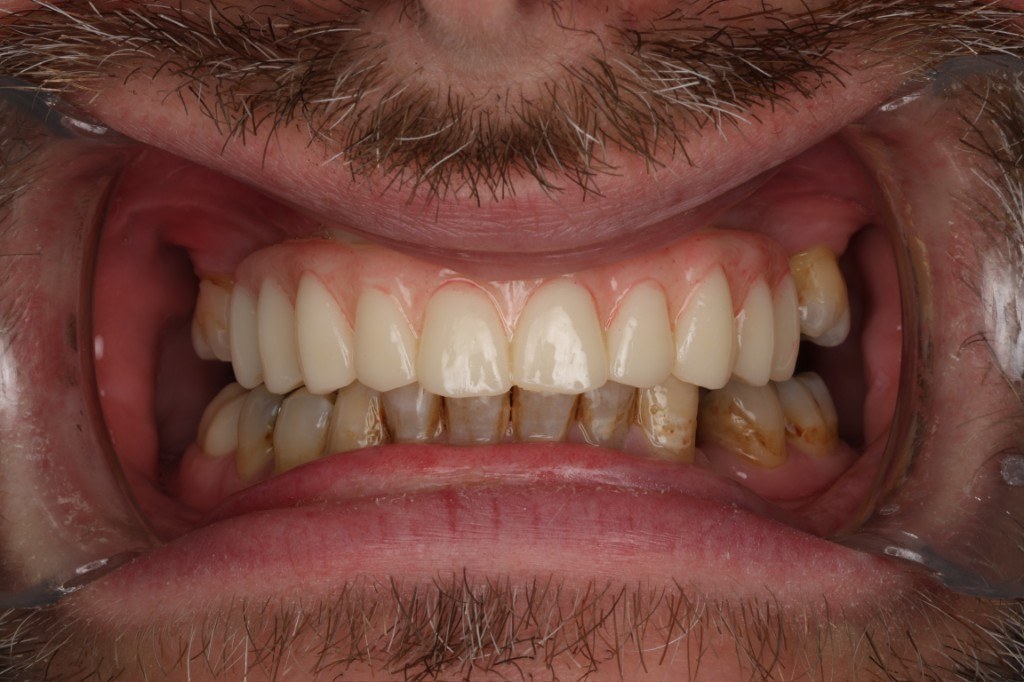 Trial fit of the implant prosthesis in the mouth.