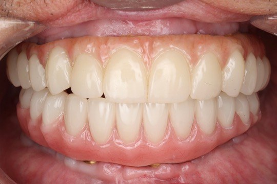 Final retracted view showing the implant prosthesis installed.