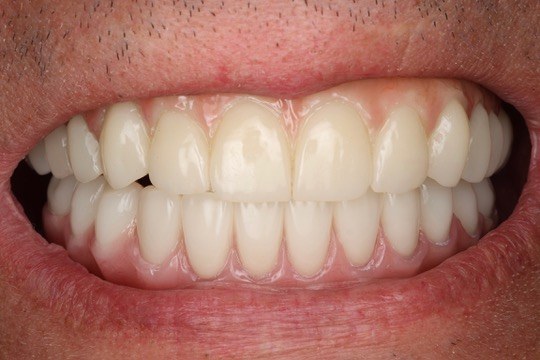 Final smile after implant restoration.