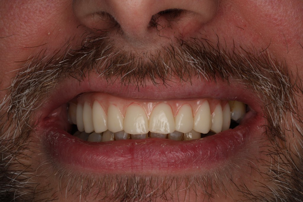 Patient smile after full-mouth implant restoration, in natural light.