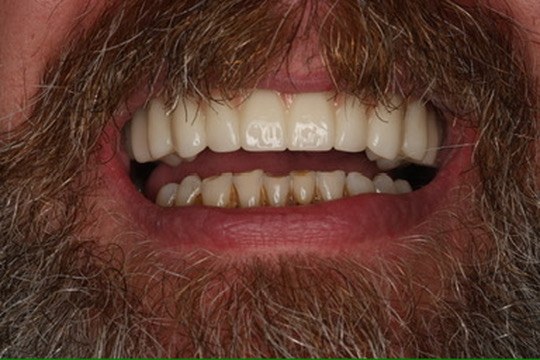 Final smile in a relaxed pose after implant restoration.