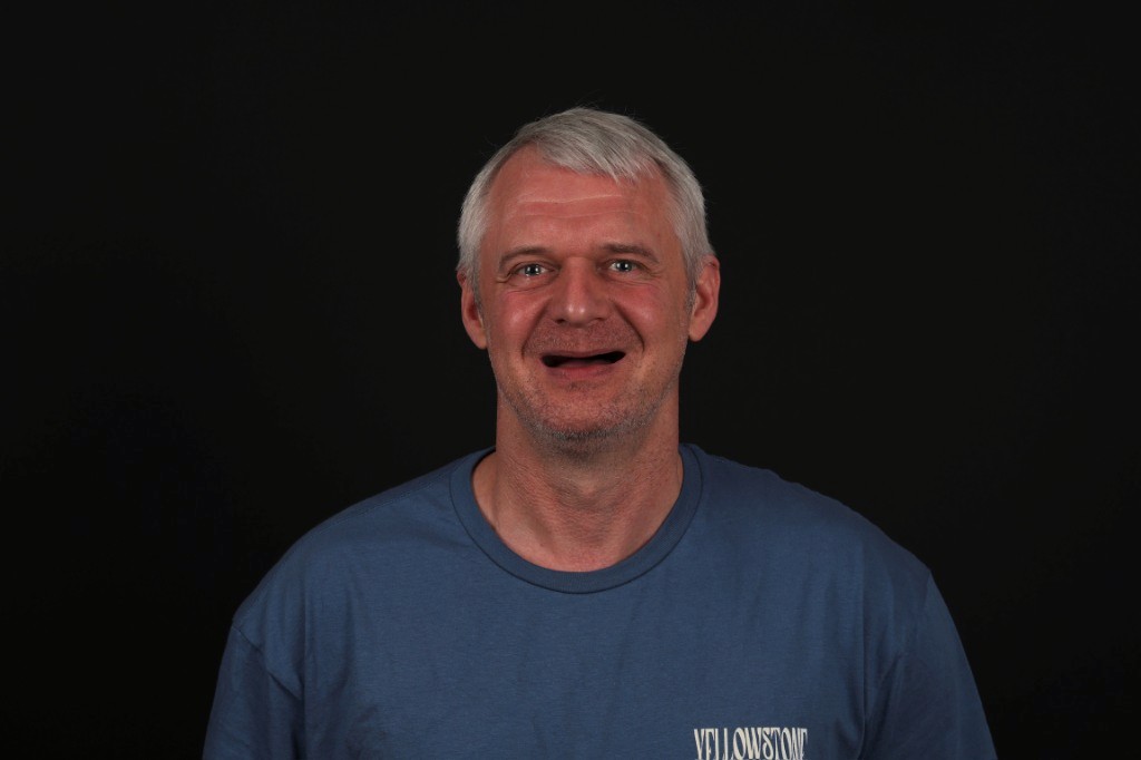 Patient one — before full-arch implant restoration; failing dentition.