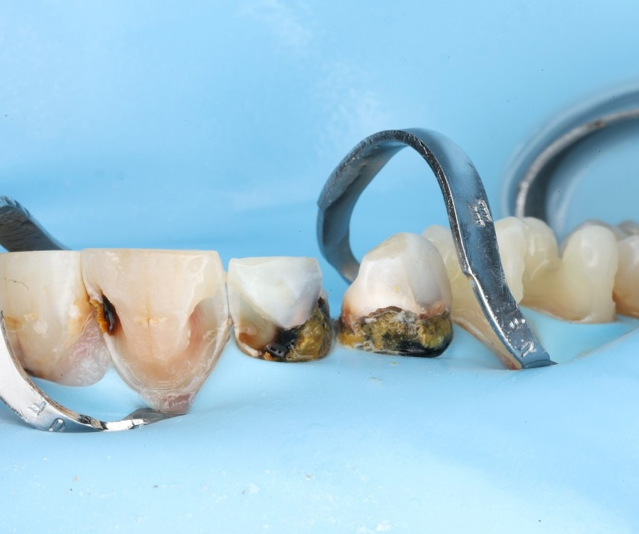 Close-up of a posterior tooth with severe decay, isolated under a blue rubber dam with a sectional matrix band in place.