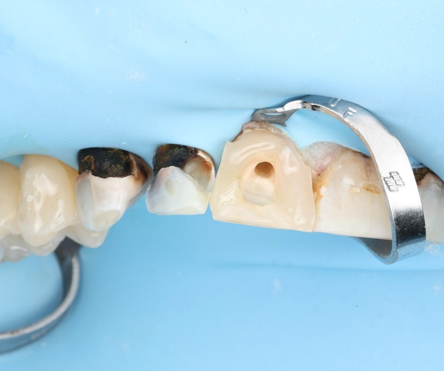 Mid-treatment access cavities on broken-down crowns, isolated under a rubber dam.