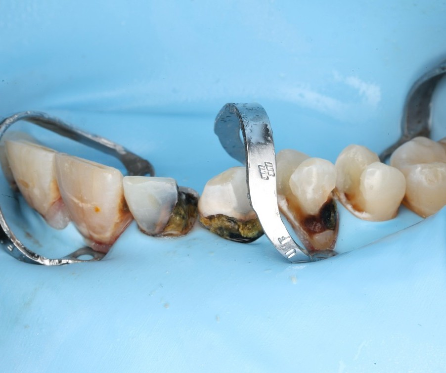 Sectional matrix bands wrapped around prepared teeth, mid build-up.