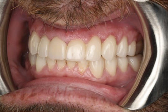 Post-op view of the restored teeth and crowns.