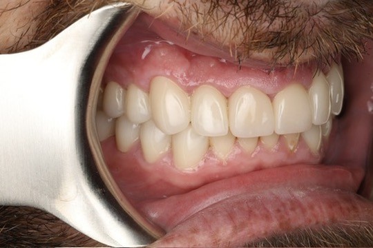 Another post-op view of the restored teeth and crowns.