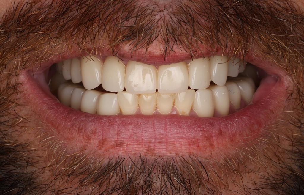 Post-op patient face — full smile restored after full-mouth endodontic rehabilitation.