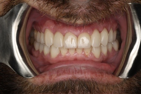 Post-op intraoral view — teeth fully restored after endodontic and restorative treatment.