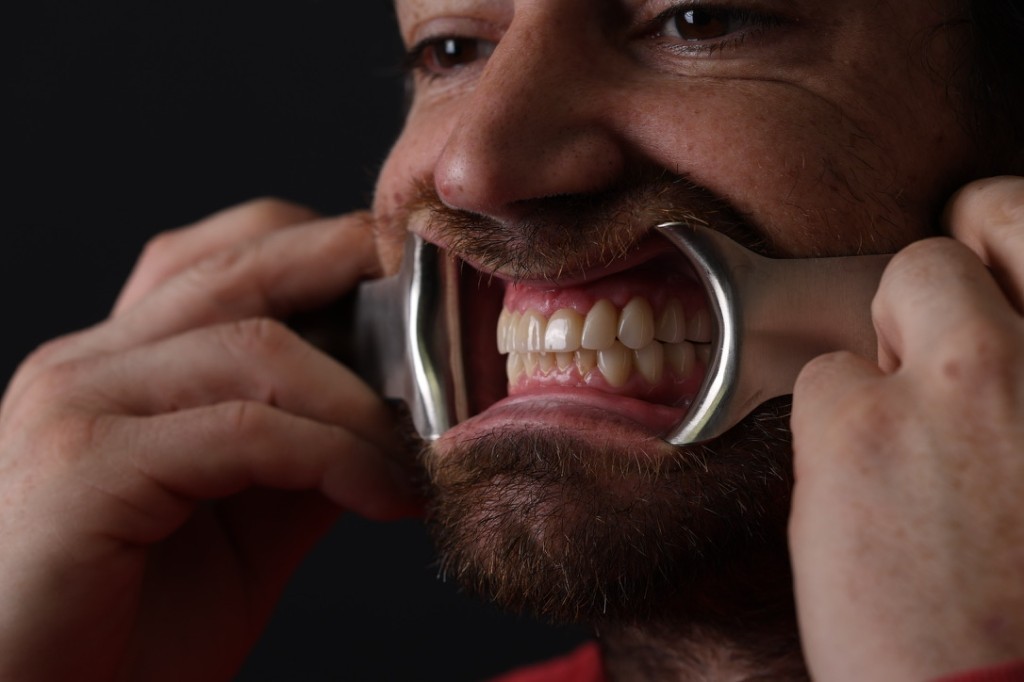 Pre-op patient face view — severe decay across multiple teeth, before treatment.