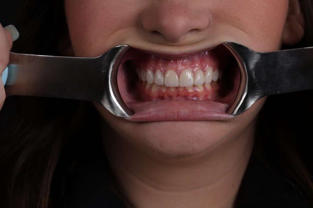 Final smile shown with a retractor — full upper and lower teeth visible after veneers.